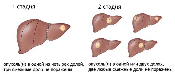 1 и 2 стадии рака печени