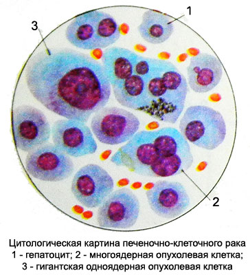 Печеночно-клеточный рак - Цитологическая картина