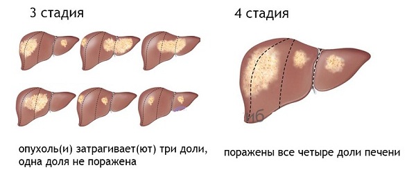 3 и 4 стадии рака печени