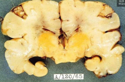 Отложение билирубина в головном мозге при ядерной желтухе