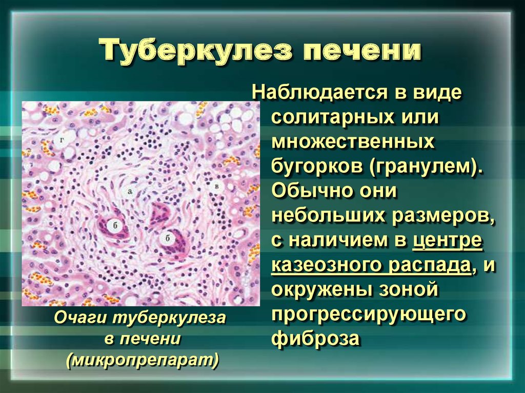 Туберкулез органа