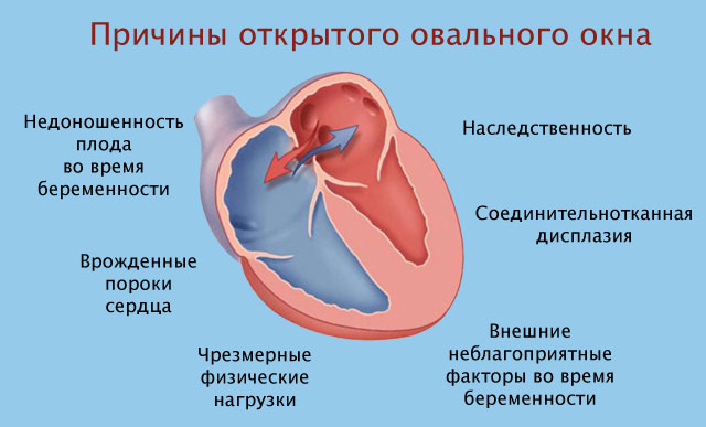 Причины открытого овального окна сердца