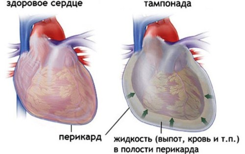 Тампонада сердца