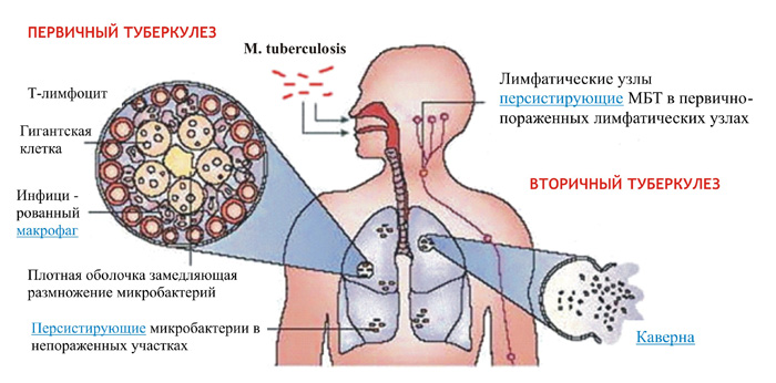 Туберкулез легких