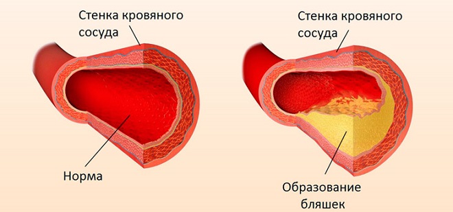 Атеросклероз