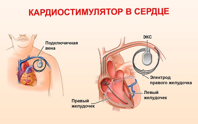 Установка кардиостимулятора