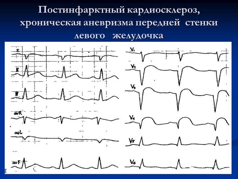 Постинфарктный кардиосклероз на ЭКГ