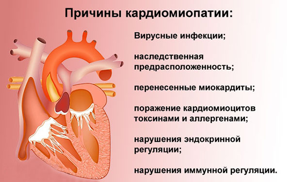 Причины кардиомиопатии