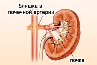Бляшка в почечной артерии