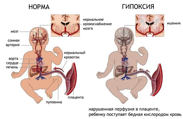 Внутриутробная гипоксия плода