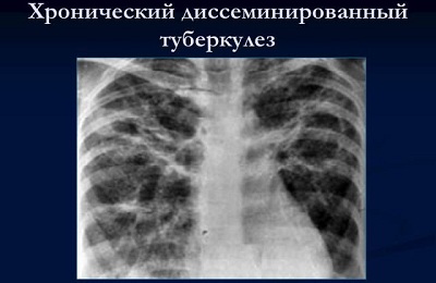 Диссеминированный туберкулез
