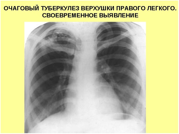 Очаговый туберкулез