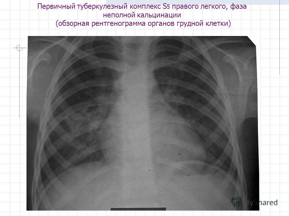 Рентгеновский снимок