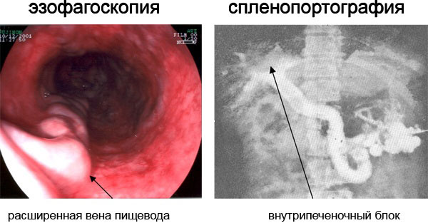 Цирроз печени варикозное расширение вен пищевода 3 степени сколько живут thumbnail