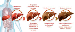 Симптомы цирроза печени у мужчин и женщин: первые признаки и как