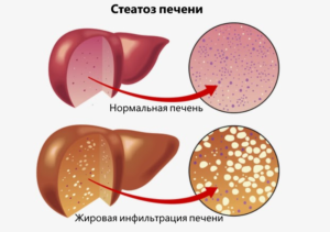 Воспаление печени: симптомы, диета и лечение у женщин имужчин