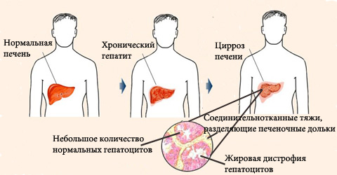 Цирроз как следствие гепатита