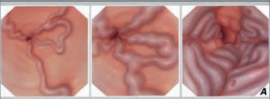 Варикозное расширение вен пищевода при циррозе печени кровотечение thumbnail