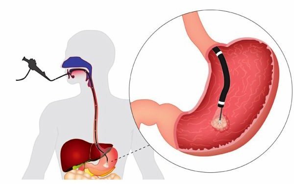 Лечение варикозного расширения вен пищевода при циррозе thumbnail