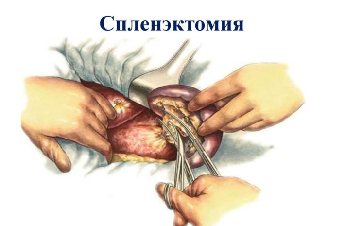 Показания к спленэктомии при циррозе печени thumbnail