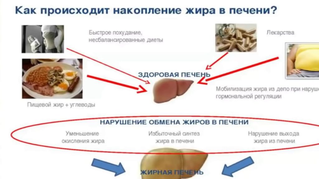 Эхогенность паренхимы печени и сосудистый рисунок при жировой инфильтрации печени следующие тест