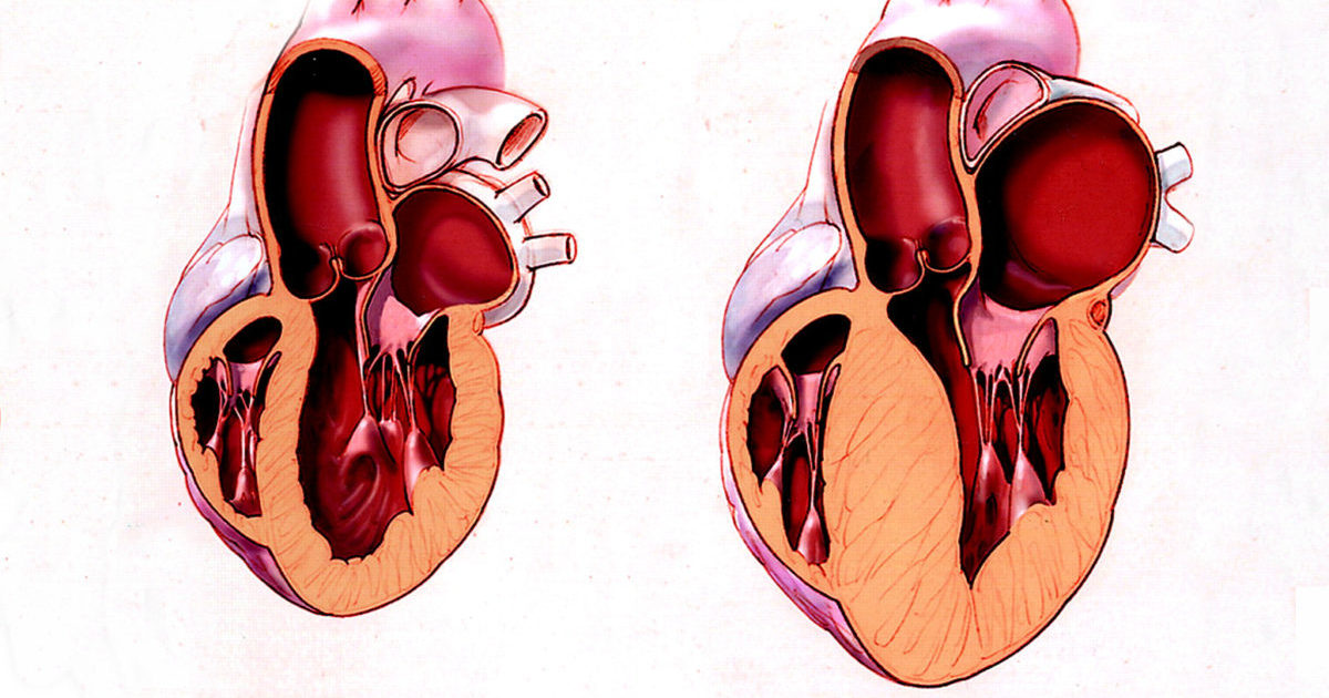 Схема гипертрофия левого желудочка