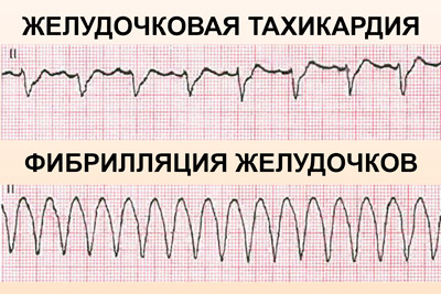 Изображение - Высокое давление пульс 150 fibrillyaciya-zheludochkov_2
