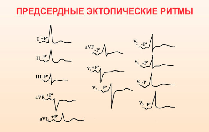 Компьютерное заключение синусовый ритм что это