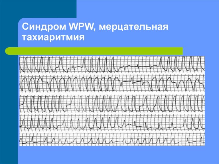 Синдром wpw карта вызова