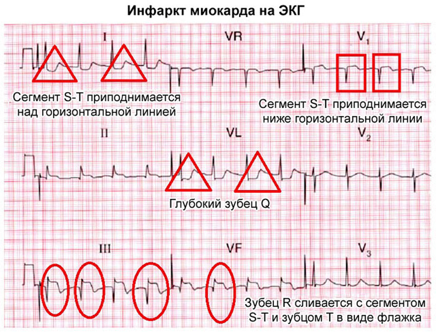 Экг 22. Изменения на ЭКГ при инфаркте миокарда. Инфаркт миокарда на ЭКГ расшифровка. Инфаркт миокарда зубцы на ЭКГ. ЭКГ при острой стадии инфаркта миокарда.