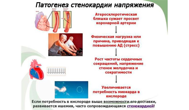 Нестабильная стенокардия прогностически неблагоприятна в плане