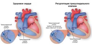 Регургитация клапана это