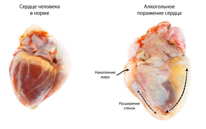 Сердечная недостаточность на фоне алкоголя