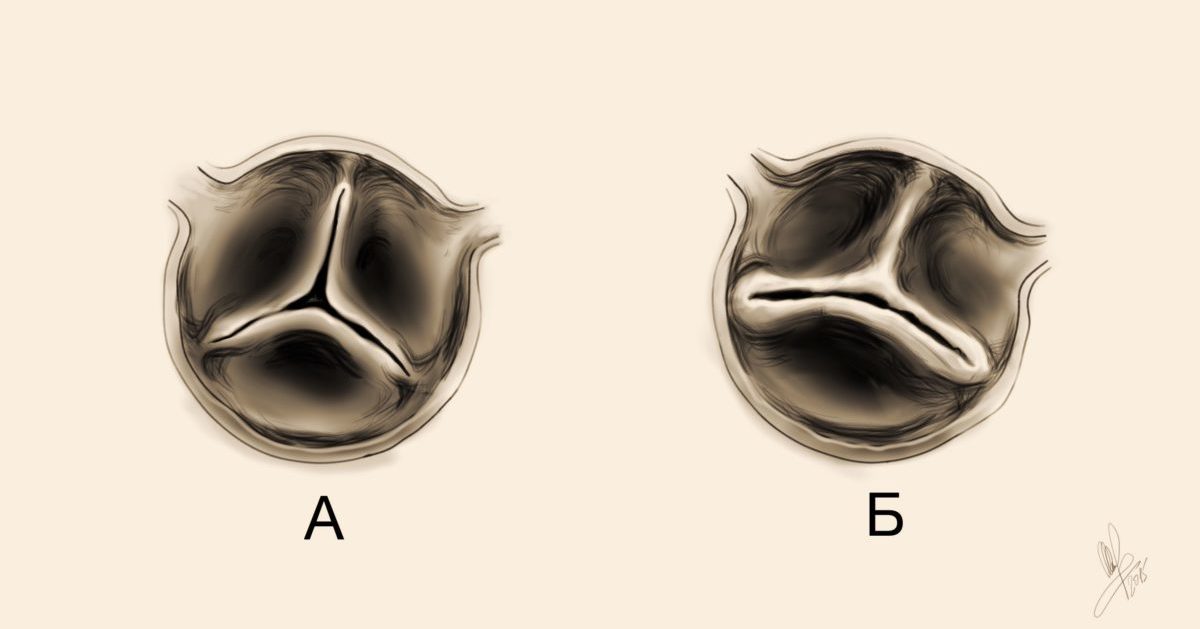 Двустворчатый аортальный клапан классификация