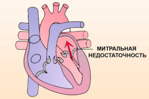 Недостаточность трикуспидального клапана лечение