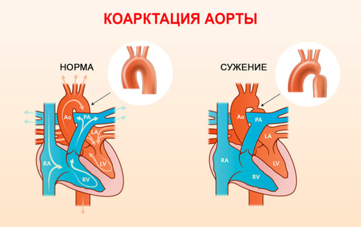 Пролапс митрального клапана стадии