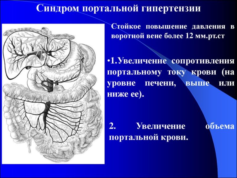 Синдром портальной гипертензии презентация