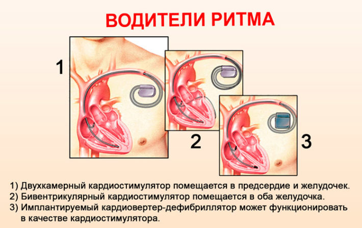 Режим кардиостимулятора ddd и ddr разница