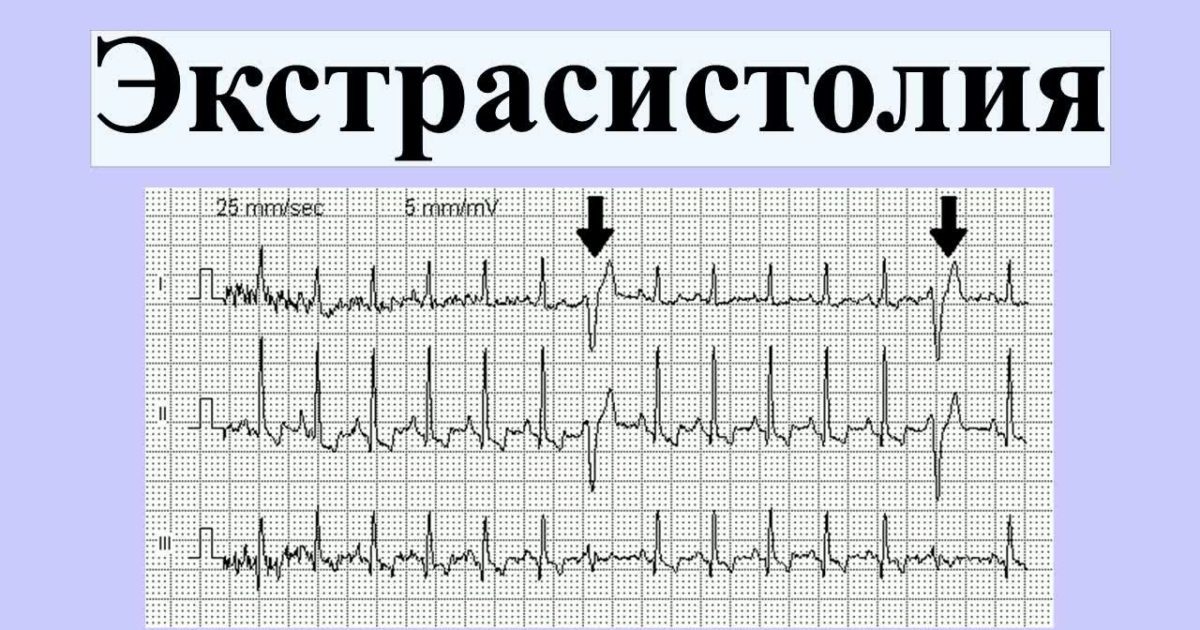 Желудочковая экстрасистолия карта вызова смп