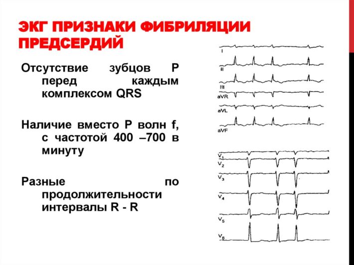 Мерцательная аритмия карта вызова скорой помощи шпаргалка