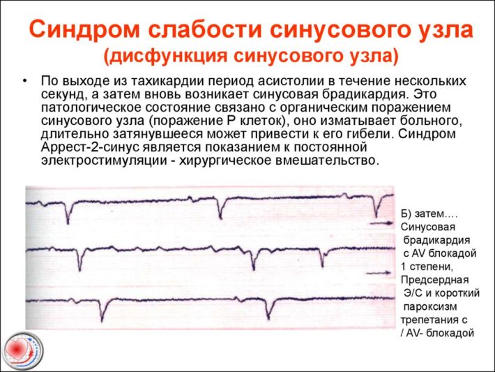 Карта вызова смп слабость синусового узла