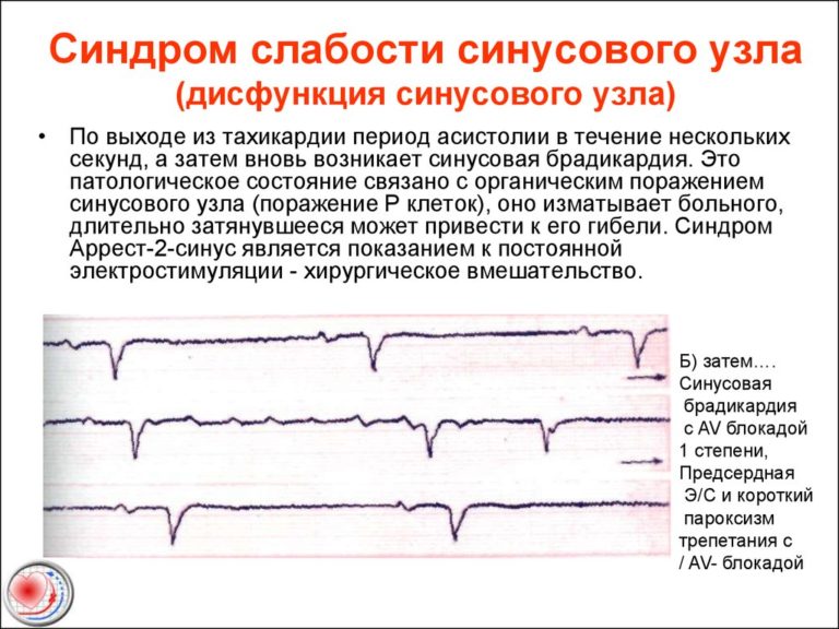 Синдром слабости синусового узла презентация