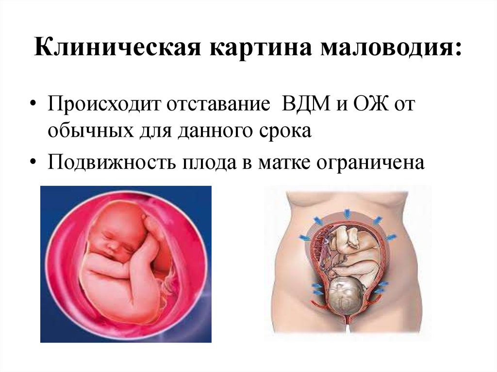 Самопроизвольные роды до 34 недель. Многоводие симптомы в 3 триместре беременности. Причины маловодия. Причины маловодия у беременных.