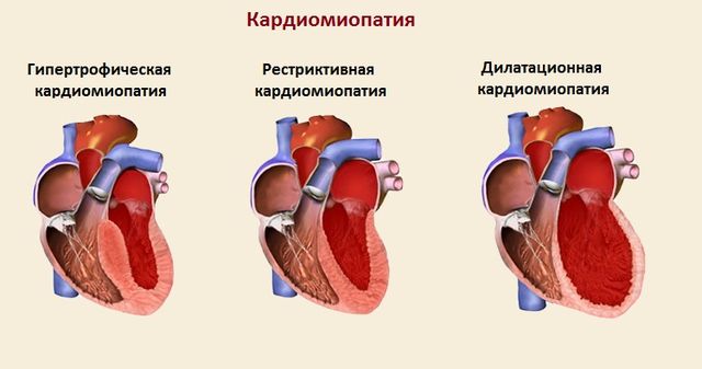 Изображение - Таблетки от давления кардосал vtorichnaya-kardiomiopatiya