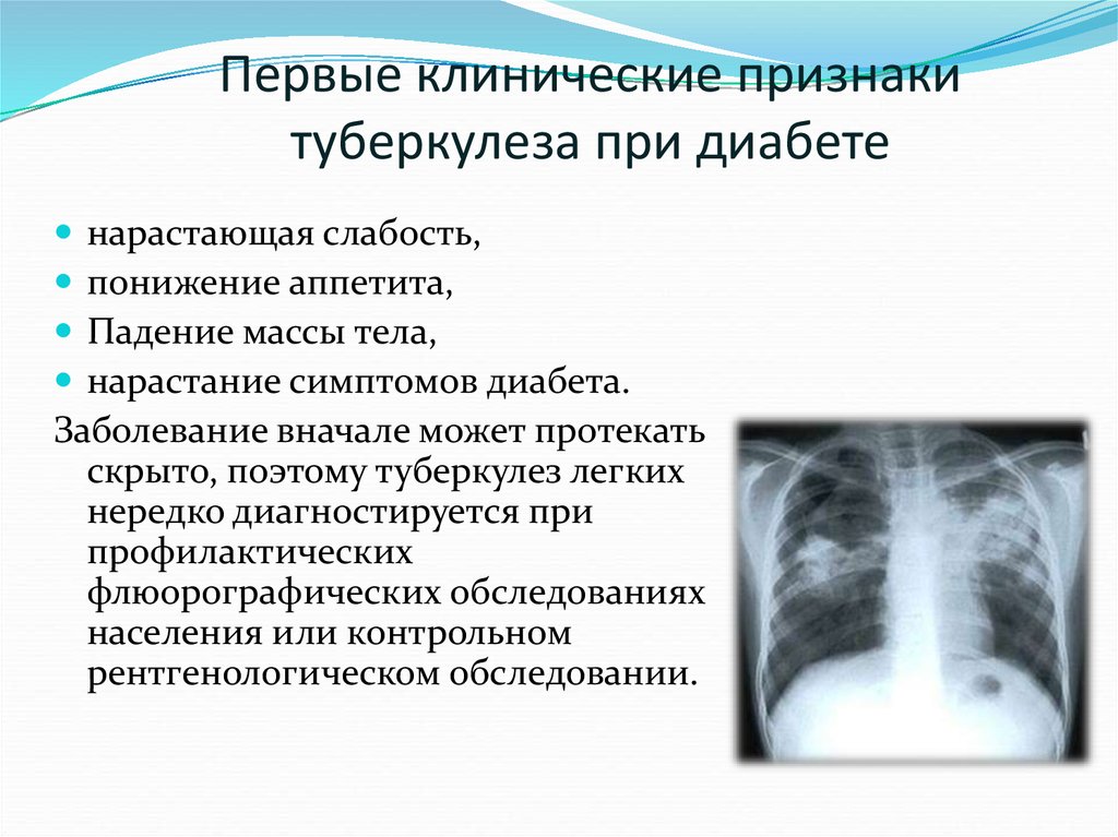 Лечение туберкулеза при сахарном диабете народными средствами thumbnail
