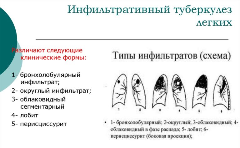 Инфильтративный туберкулез легких презентация