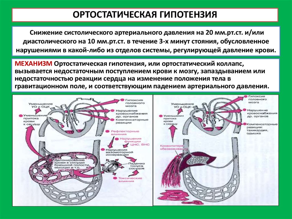 Ортостатическая гипотензия