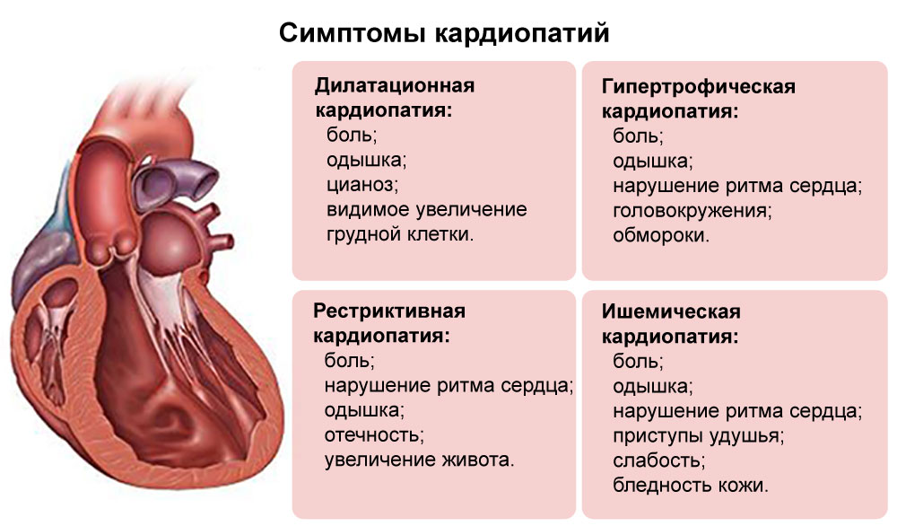 Ишемическая кардиопатия