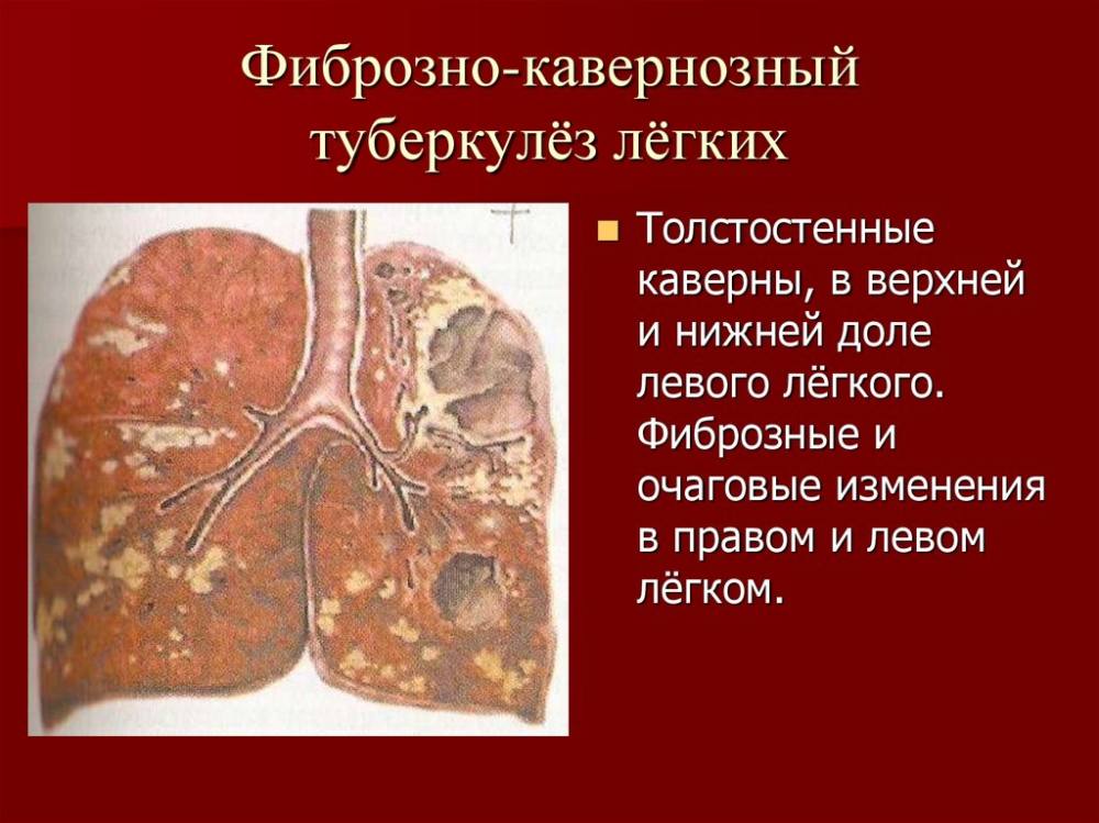 Кавернозный туберкулез