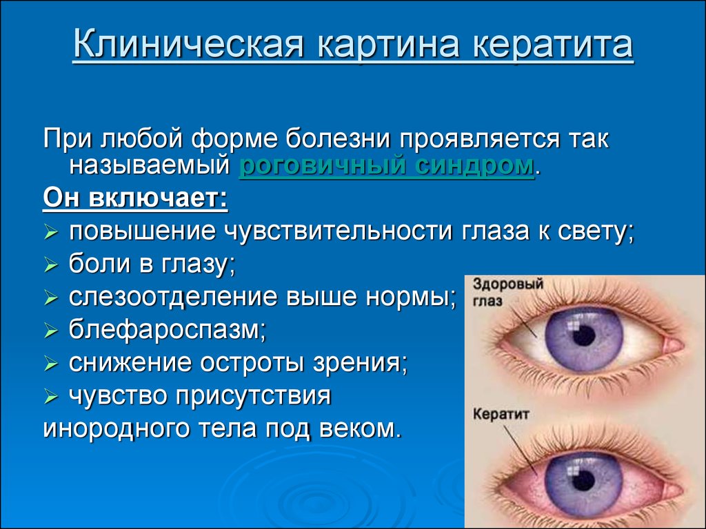 Для лечения заболевания глаз применяют 0.5. Кератит (воспалительный процесс в роговице глаза).. Кератит роговичный синдром. Конъюнктивит герпетический кератит.